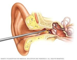 cleaning earwax